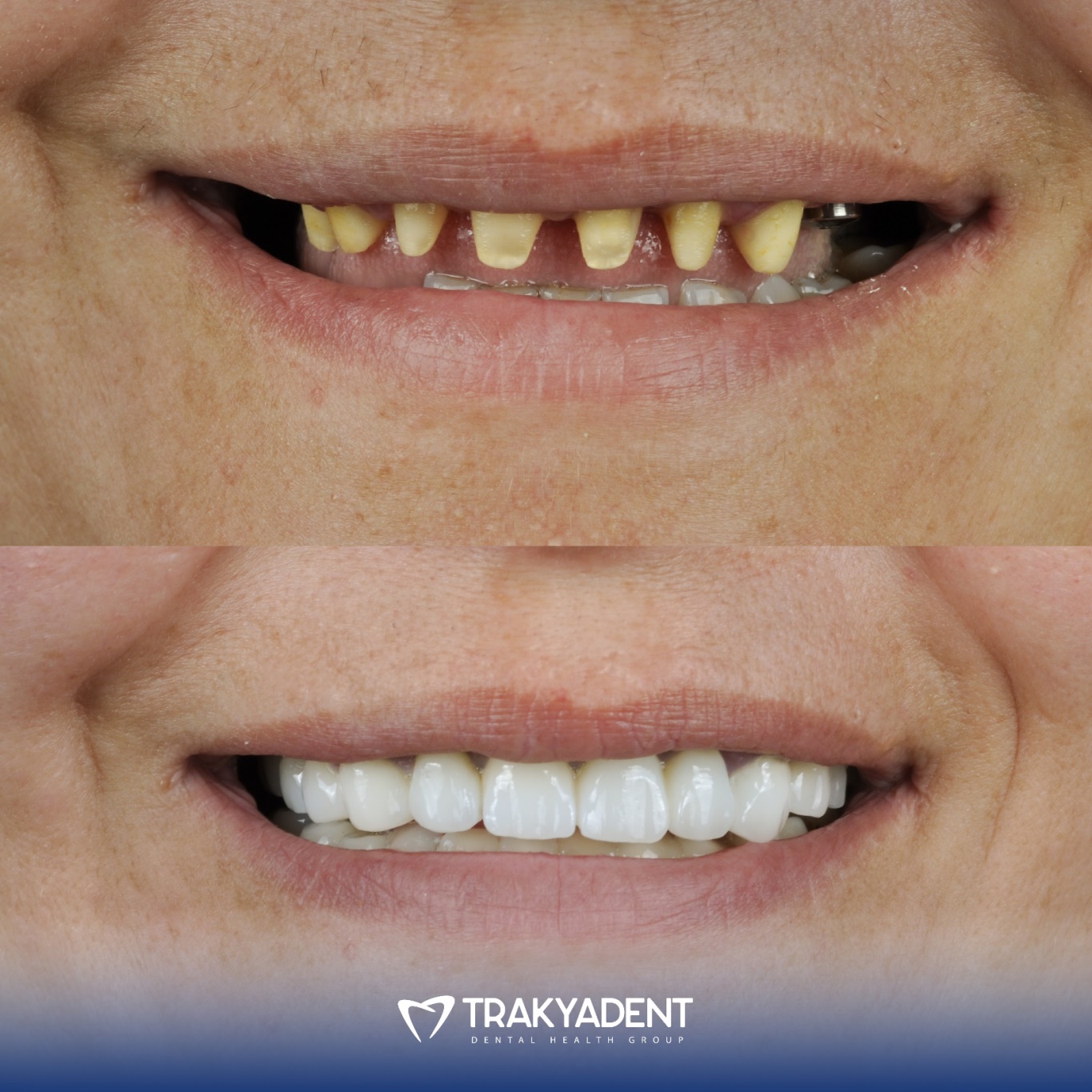 Dental treatment before and after - Case 4