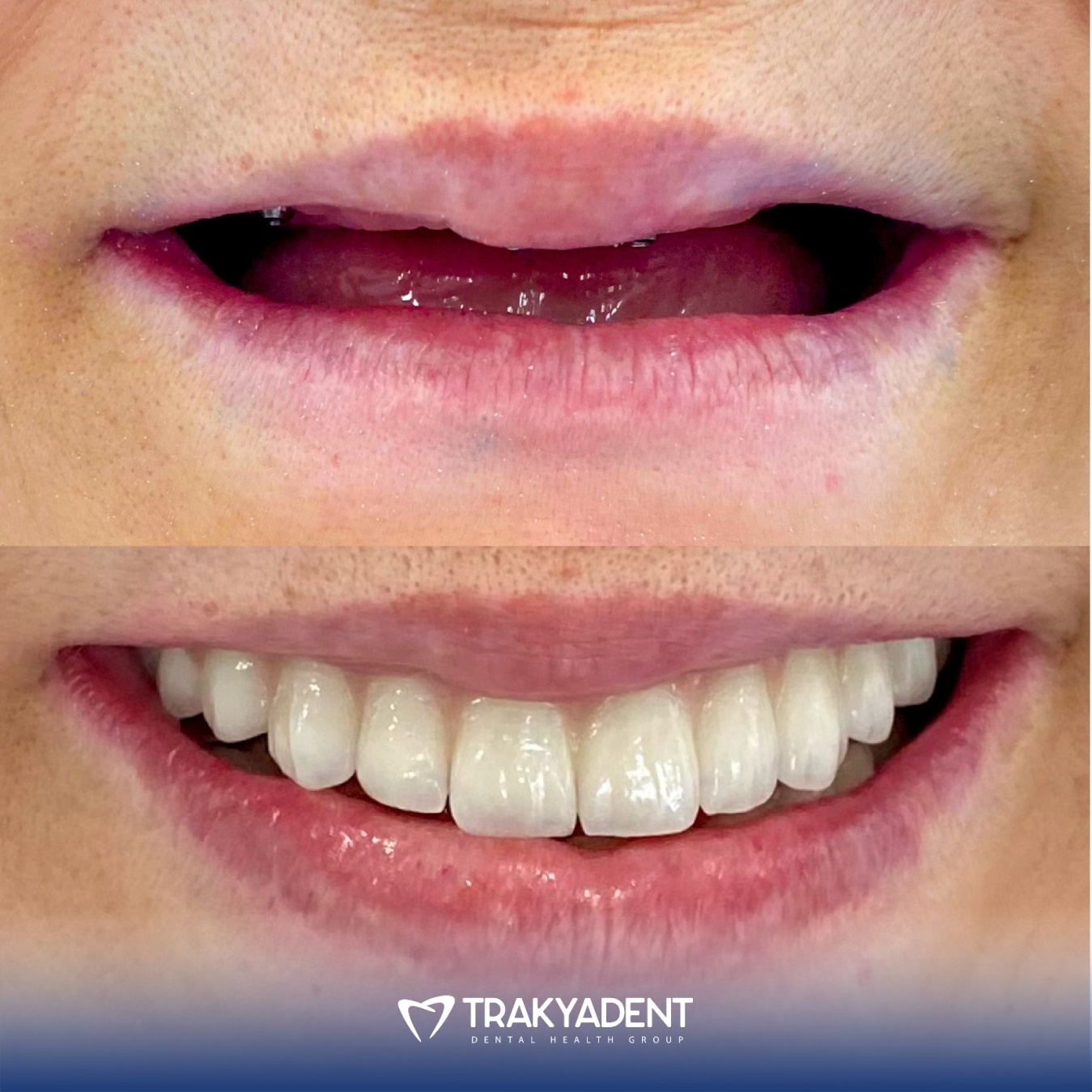 Dental treatment before and after - Case 1