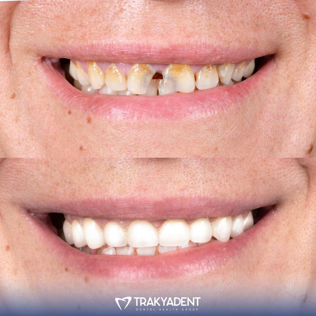 Dental treatment before and after - Case 2