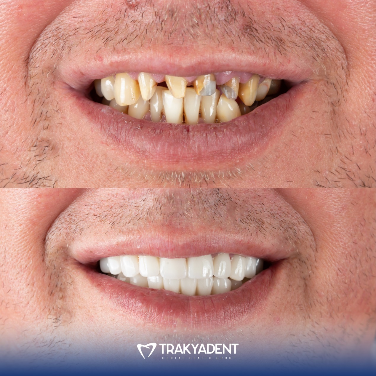 Dental treatment before and after - Case 3
